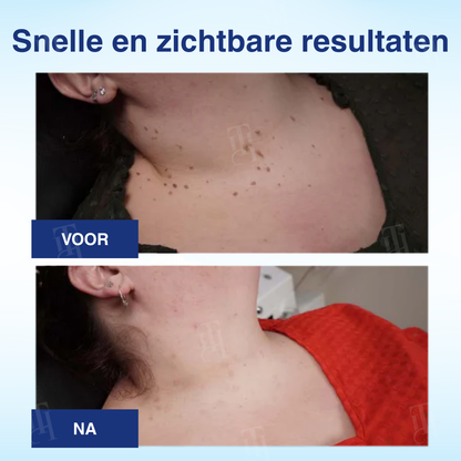 🌟 Officiële winkel | RZXEA™ AHA Wrattenverwijderingsvloeistof